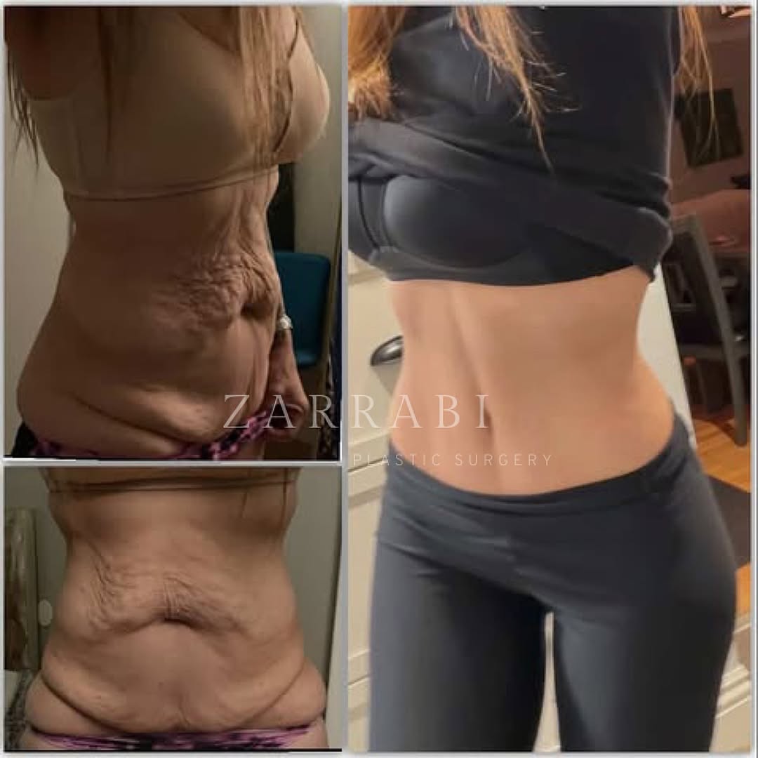 Instagram post by Dr. Michael Zarrabi: Our patient is living it up with her new tummy 🤩 By removing excess skin her tummy looks brand new, her abdominal muscles now have the chan…