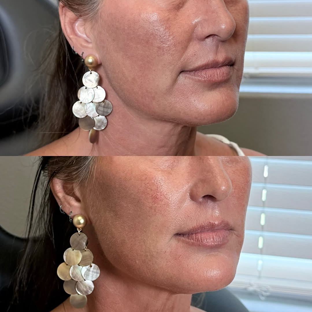 Instagram post by Dr. Michalynn Farley: A little Voluma in the correct places, goes a LONG way! Procedure: Cheek/chin filler Product: Voluma XC Cost: $800 Duration: 2 years Results…
