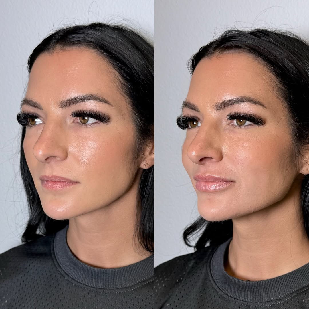 Instagram post by Dr. Michalynn Farley: Beautiful lips for a beautiful girl inside and out! This was the most fun I’ve had in a while! RHA 3 used for this perfect pout! 💗💗 #dmtob…