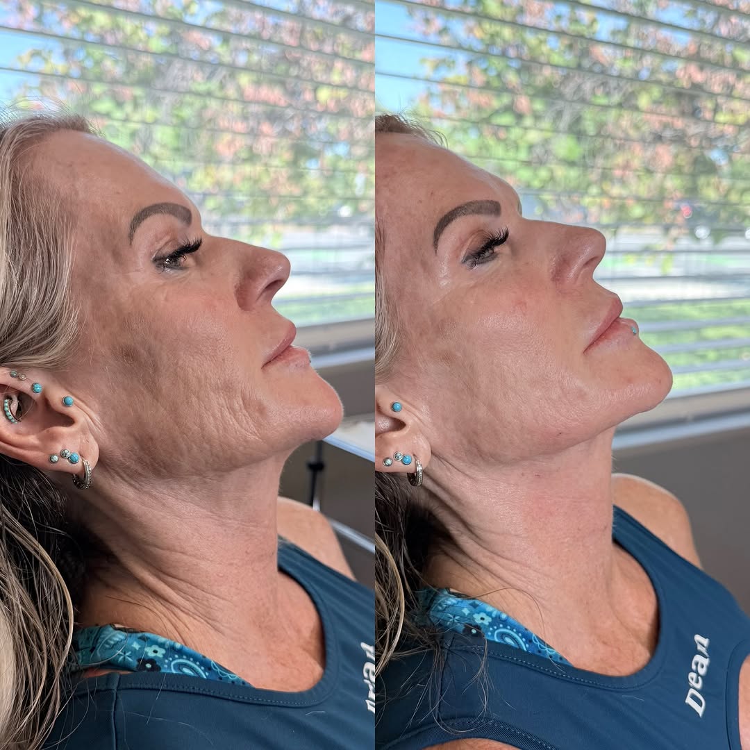 Instagram post by Dr. Michalynn Farley: Filler in places you would have never thought… but it fully brings the face together! Can you guess where? 😉🤫 #filler #voluma #volux #aest…