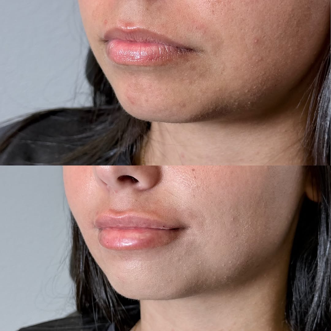 Instagram post by Dr. Michalynn Farley: Subtle and beautiful, as always! We completely changed her look and she was THRILLED! 😁 #lipfiller #rha2 #aestheticnp #artistryaesthetics #…
