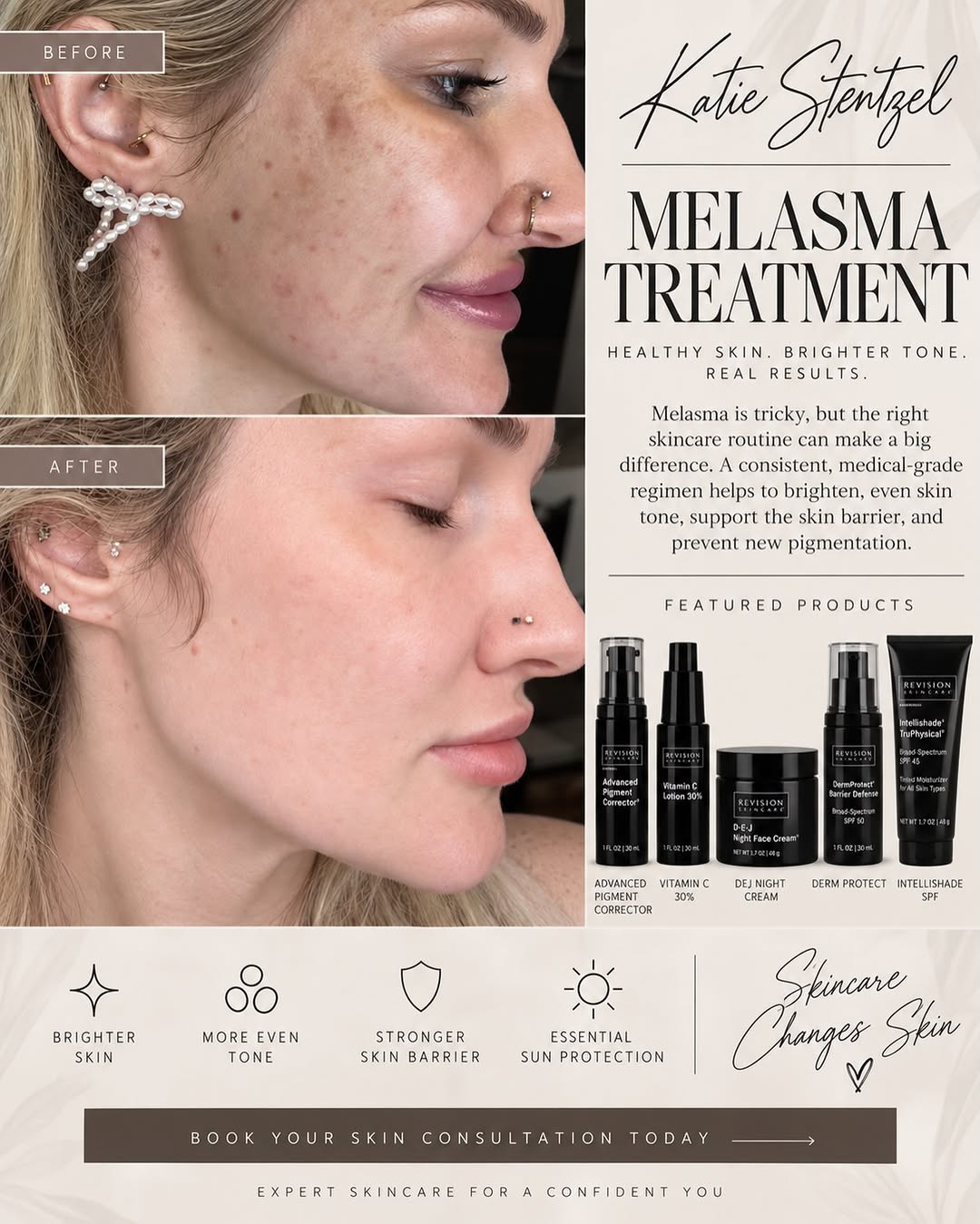 Instagram post by Dr. Michalynn Farley: MELASMA IS TRICKY… but the right skincare routine can make a BIG difference. 🤍 Melasma isn’t something I believe in aggressively chasing wi…