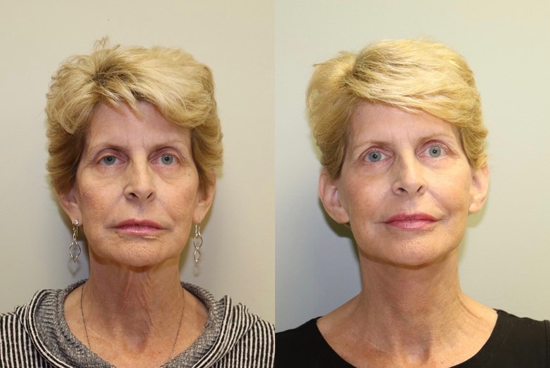 Instagram post by Dr. Michel C. Samson: Look at these results! This patient had a facelift, upper & lower blepharoplasty and bilateral earlobe reduction with Dr Samson! What a tran…