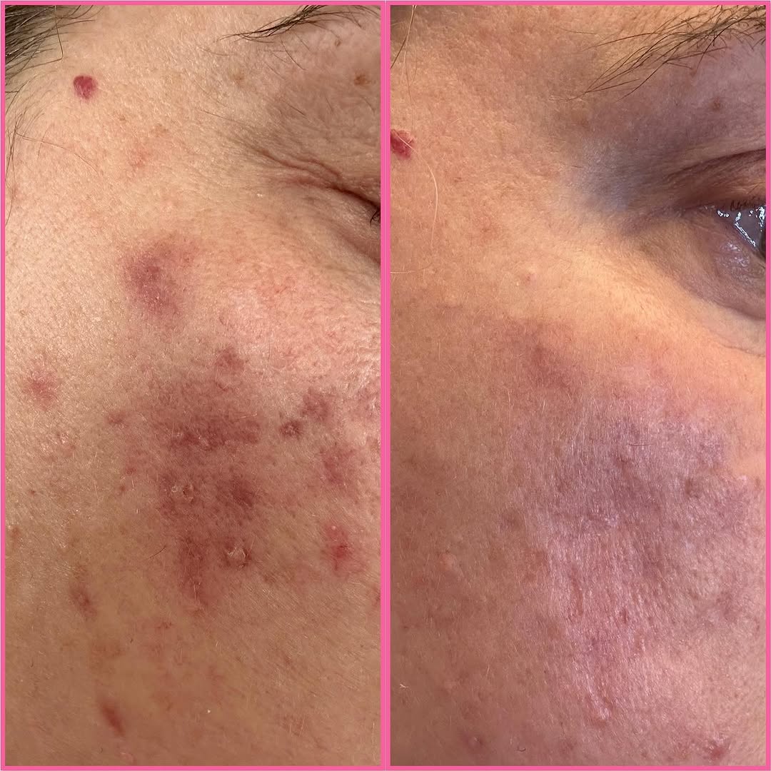 Instagram post by Dr. Michel C. Samson: Before & afters from microneedling! This client had 3 sessions to improve her acne scars and WOW 🤩 what an improvement! Call us today 386-7…