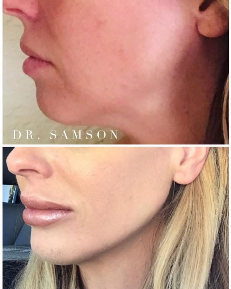 Instagram post by Dr. Michel C. Samson: Dr. Samson’s Wednesday is full of #botox #dermalfiller #facialbalancing #plasticsurgery patients. We especially love this lower face transfo…
