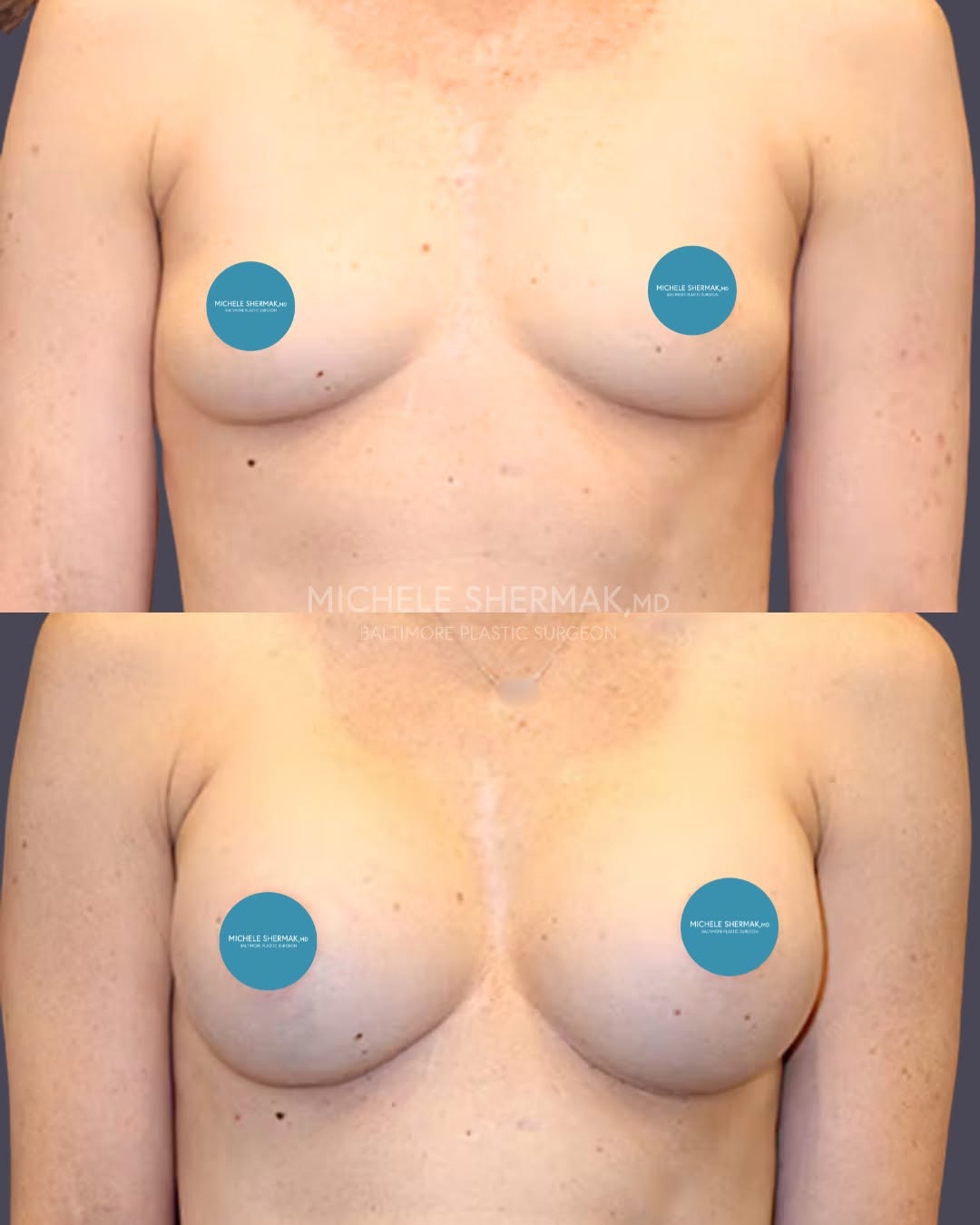 Instagram post by Dr. Michele A. Shermak: This beautiful patient wanted to restore her shape and fullness after having a child. With a high-profile gel implant placed under the pecto…