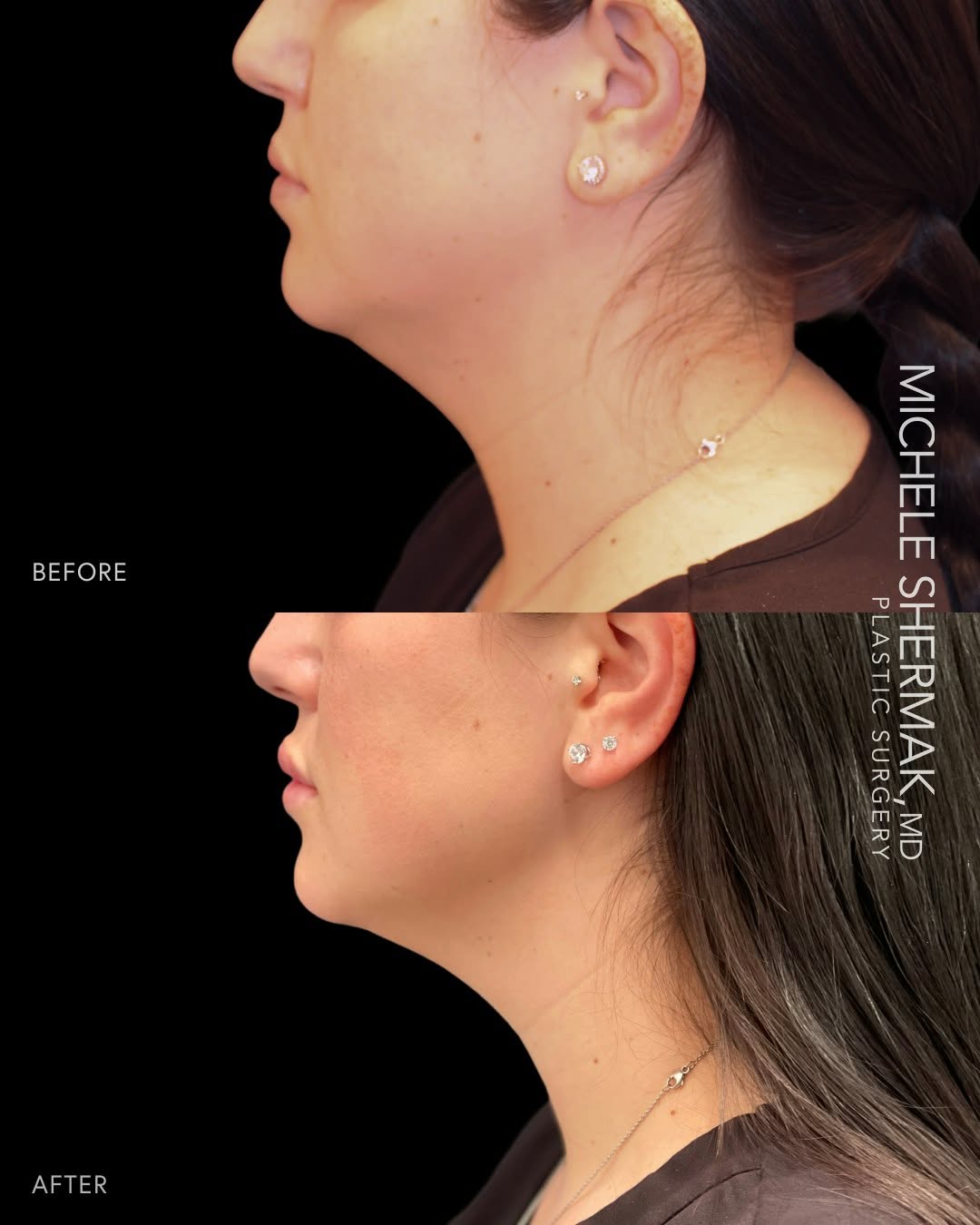 Instagram post by Dr. Michele A. Shermak: One treatment. Five weeks. A completely new profile. Kybella continues to be one of the most effective ways to address submental fat without…