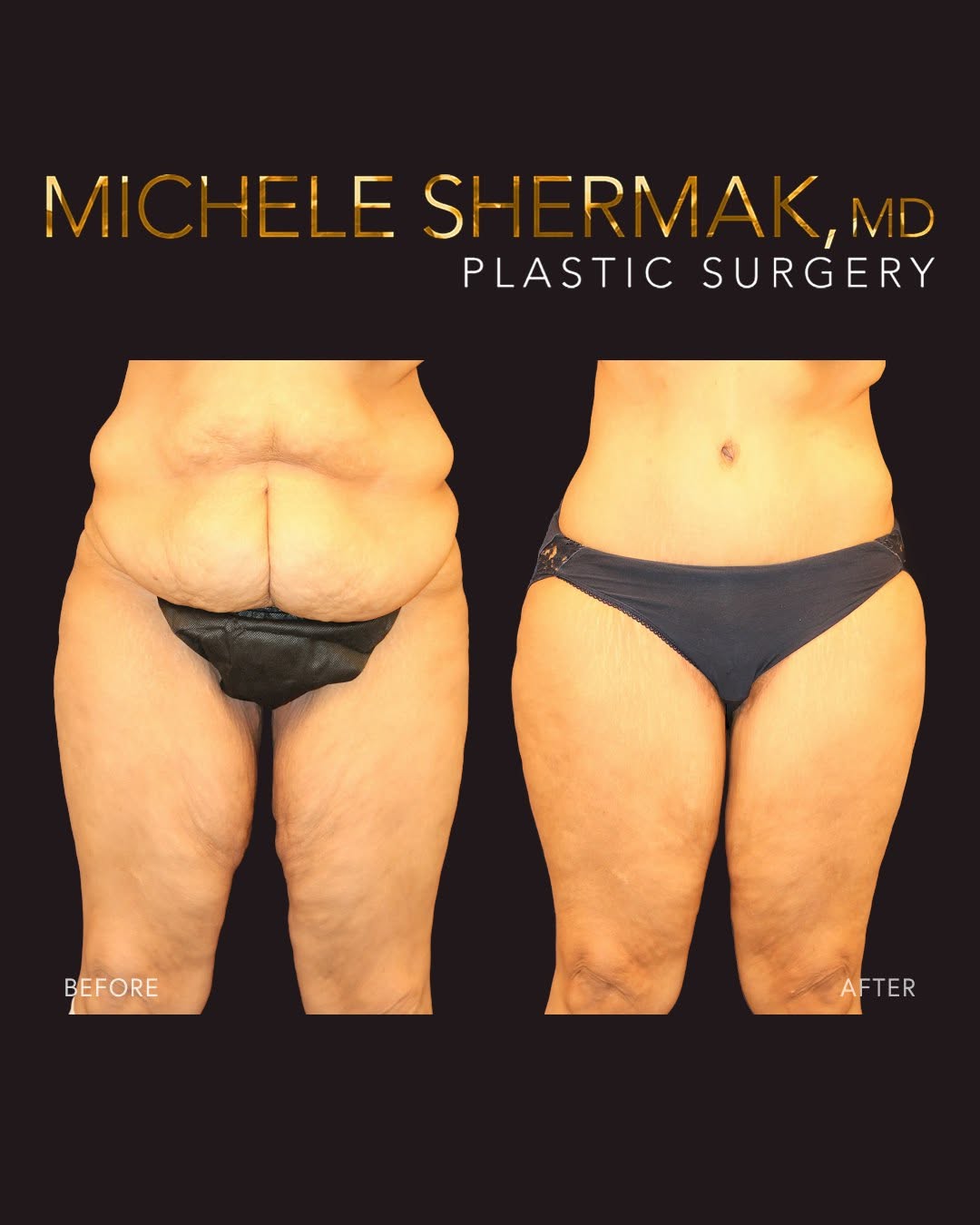 Instagram post by Dr. Michele A. Shermak: Nearly two years after apex thighlift, abdominoplasty, and liposuction following massive weight loss, this patient's transformation reflects…