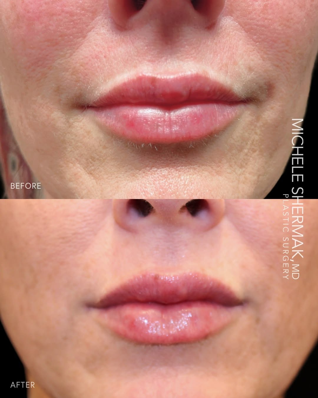 Instagram post by Dr. Michele A. Shermak: Sometimes the best filler result is the one you can barely see. One syringe of Kysse brought balance and hydration to the upper and lower li…