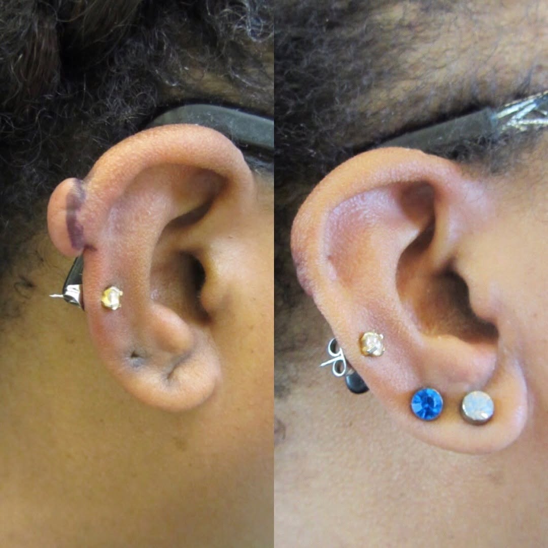 Instagram post by Dr. Michele Burgess: Keloids are formed then the body produces too much scar tissue in response to an injury (cut, tattoo, piercing). Here is our latest removal,…