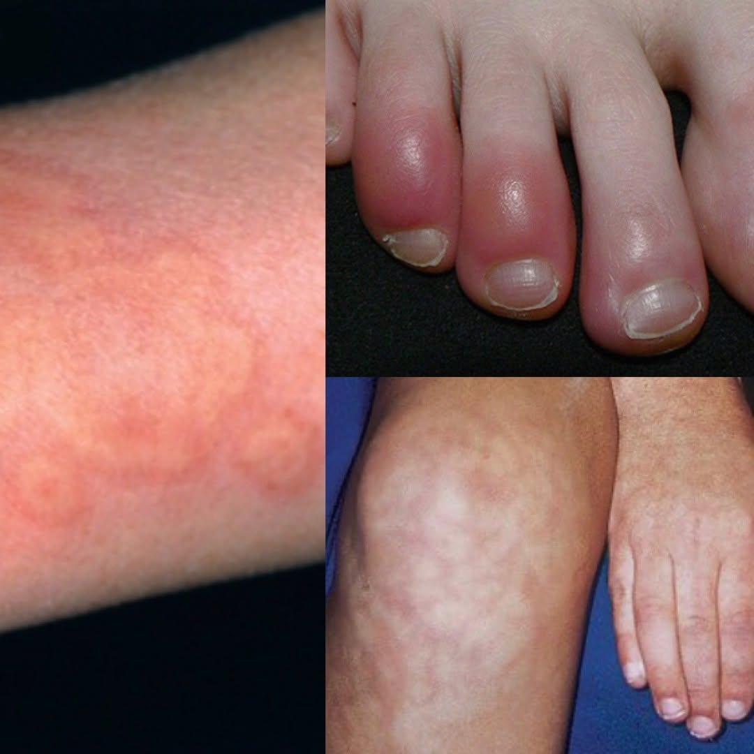 Instagram post by Dr. Michele Burgess: Up to 20% of Covid-19 patients may have skin findings including new onset hives, acral ischemia (Covid toes), petechiae (broken blood vessel…