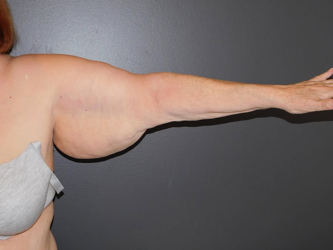 Instagram post by Dr. Michele DeVito: 👀 wow 🤩 Swipe ➡️ for the amazing after ! #brachioplasty #armlift #lipo #plasticsurgery #plasticsurgeon #body #selfcare #confidence #aesthe…