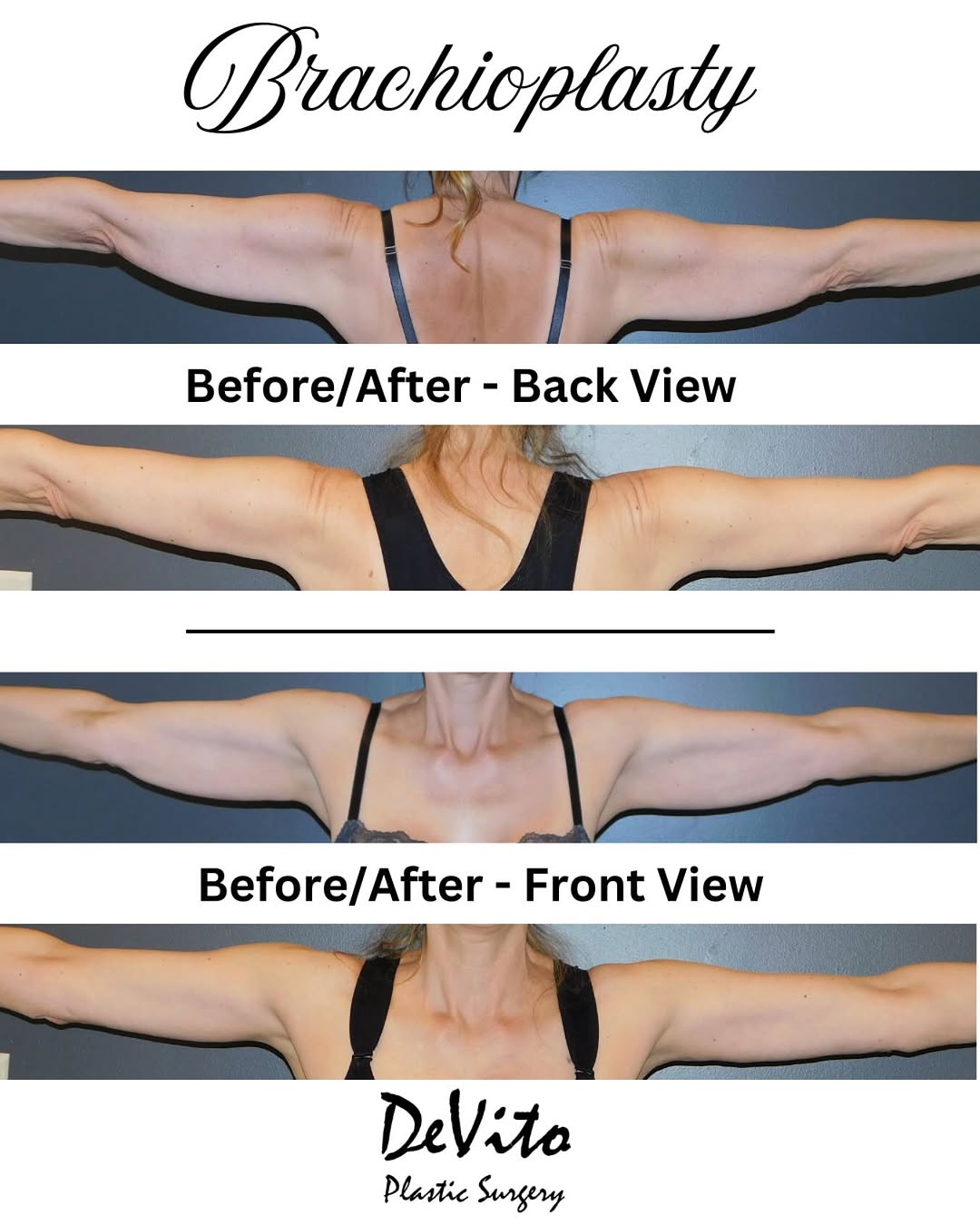 Instagram post by Dr. Michele DeVito: What is a brachioplasty? It’s a procedure which surgically removes excess skin and fat from the upper arms. It helps tighten and contour the…