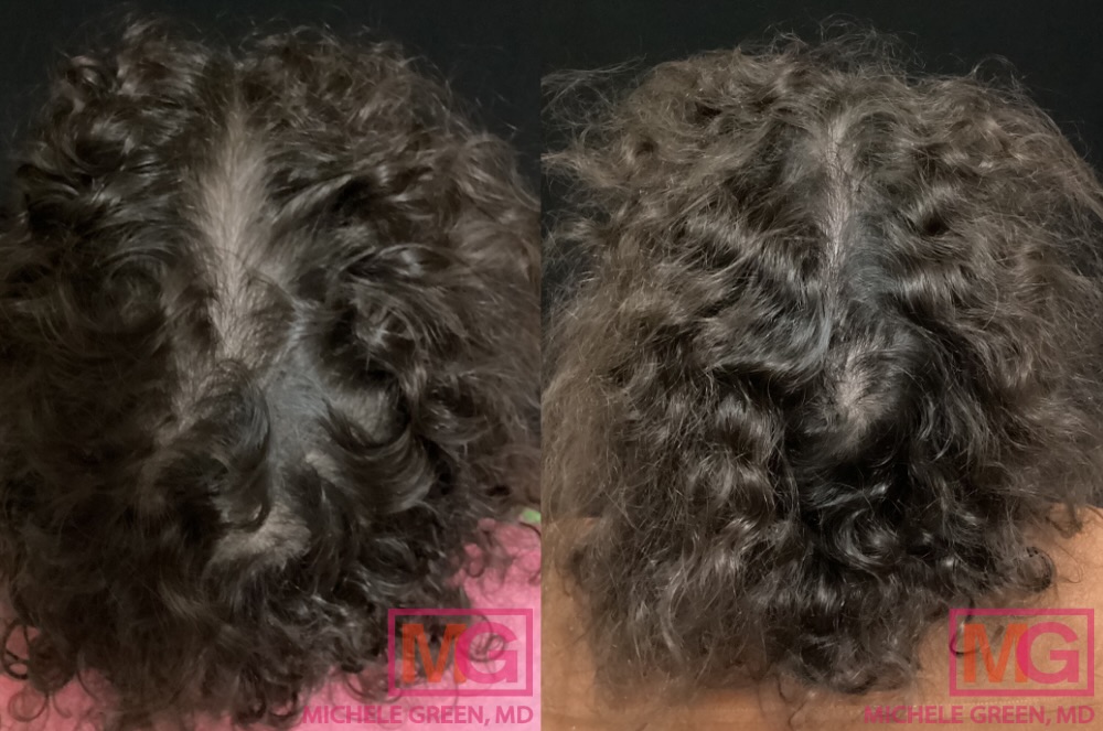Instagram post by Dr. Michele S. Green: Before & After Dr. Michele Green is an expert in hair loss in NYC and has helped thousands of men and women with their hair issues. Contact …