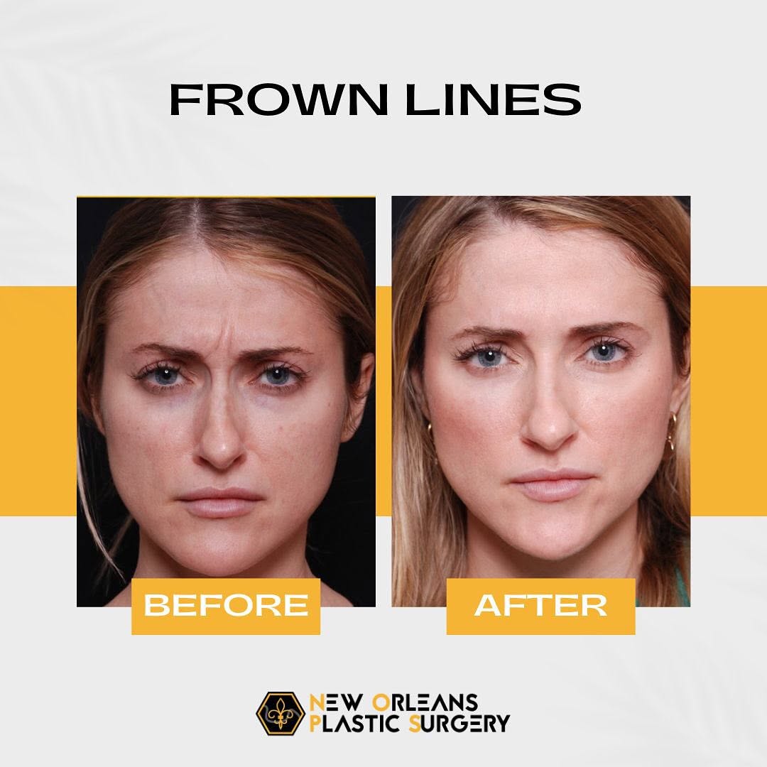 Instagram post by Dr. Michelle Eagan: Frown lines got you down? 😕 Before: deep wrinkles can make you feel self-conscious about your appearance. After: a quick and easy treatment…