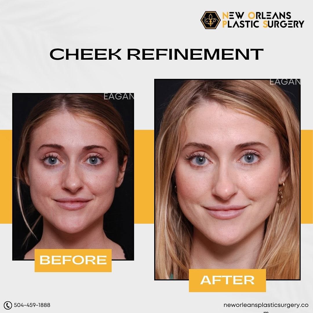 Instagram post by Dr. Michelle Eagan: 🔥 Get ready to glow from the inside out! 💃 Did you know that refined cheekbones can make a huge difference in your facial structure? 🤯 By…