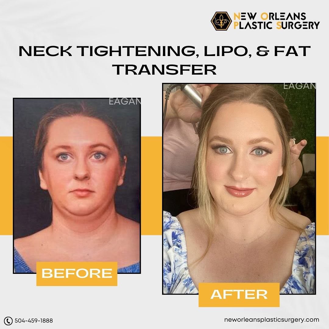 Instagram post by Dr. Michelle Eagan: 💫 Before and after about 6 weeks neck tightening, lipo and fat transfer. She looks like a Disney princess! 💫