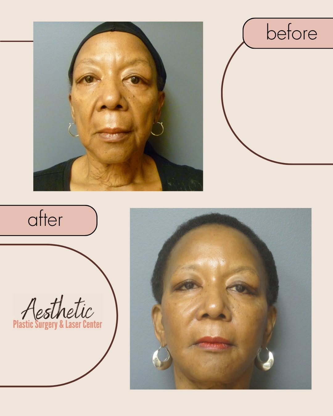 Instagram post by Dr. Michelle Hardaway: Facelift, neck lift, and facial fat transfer for a 66-year-old patient, shown at eight months post-op. The three procedures do three differe…