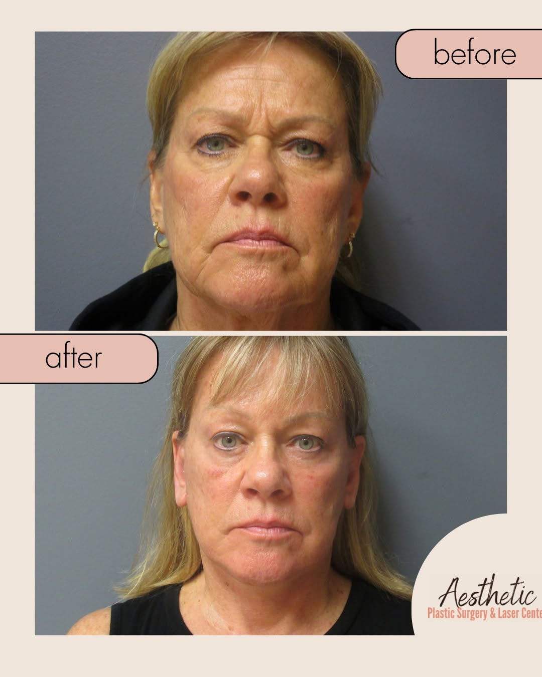 Instagram post by Dr. Michelle Hardaway: 3 weeks post-op: Mini facelift, endoscopic brow lift, and neck lift for a 66-year-old patient. We’re posting this early on purpose. Most bef…