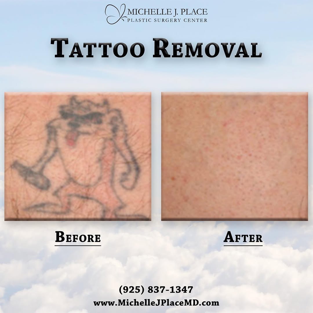Instagram post by Dr. Michelle J. Place: Tired of looking at that old and faded tattoo that you thought was a good idea in college? Contact us today to learn about our tattoo remova…