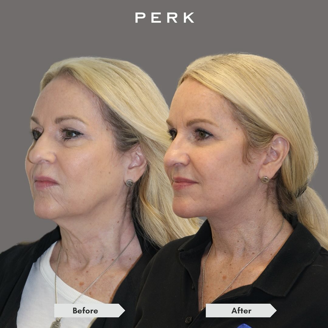 Instagram post by Dr. Michelle Lee: Our patient is 6 months after #deepplanefacelift and necklift and #fattransfer. Her goal is to look natural and refreshed. The downtime was …