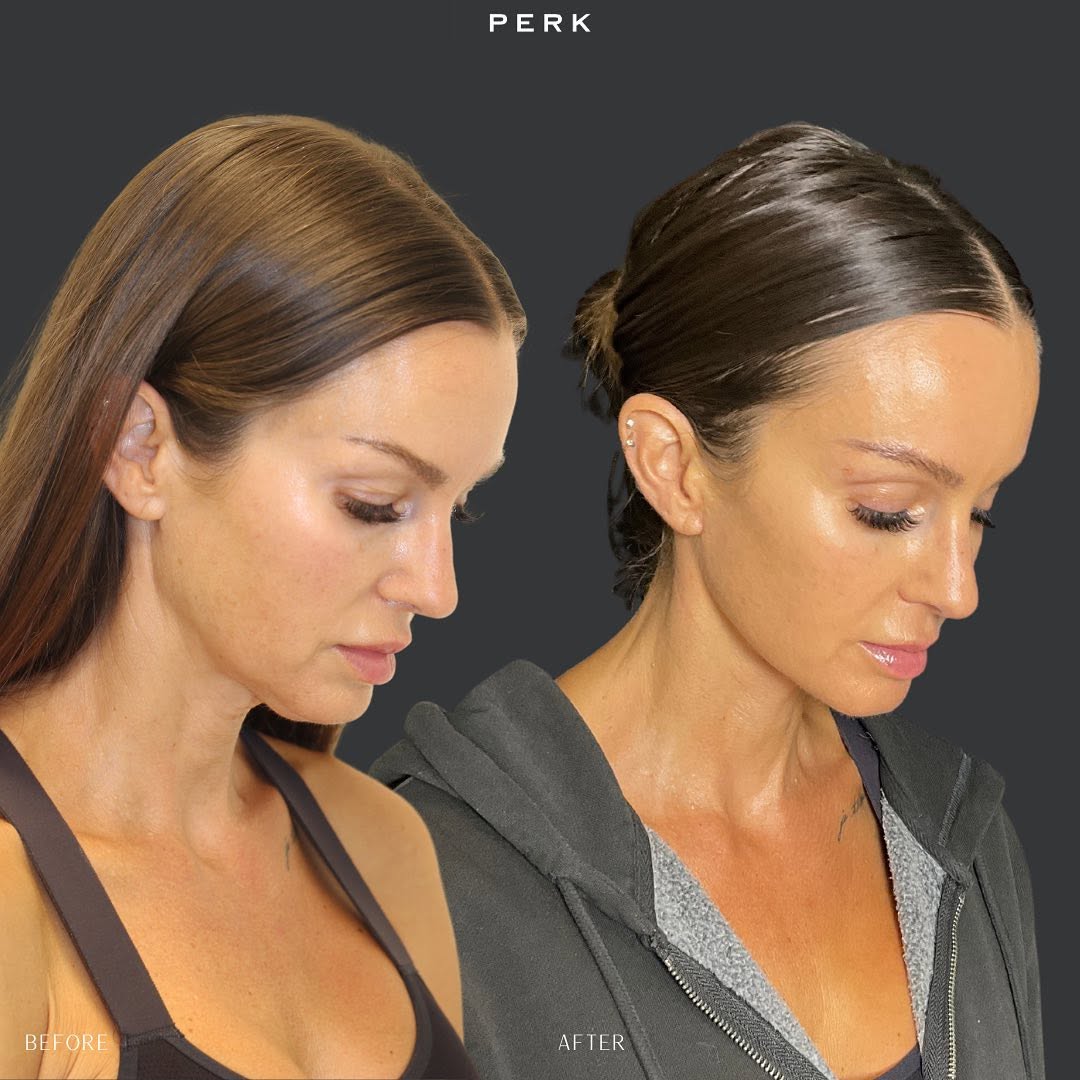 Instagram post by Dr. Michelle Lee: Another Friday, another transformation: Meet our radiant patient, Jen! 🌟 After undergoing a neck lift procedure with us, she's not only glo…