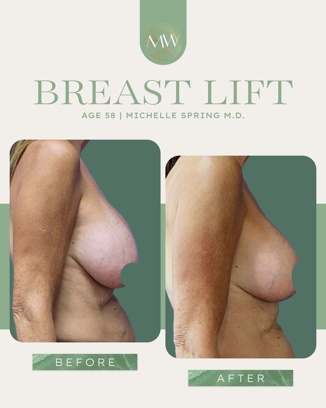 Instagram post by Dr. Michelle Spring: At 58 years old, this active patient came to us wearing a size DD with silicone implants that no longer fit her lifestyle, hoping for a smal…