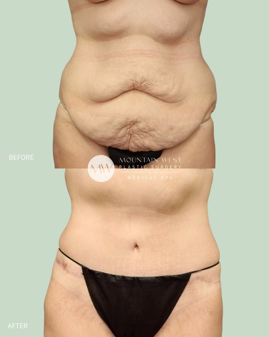 Instagram post by Dr. Michelle Spring: At 28 years old, this patient came to us following significant weight loss, hoping to remove the excess skin left behind and finally see her…
