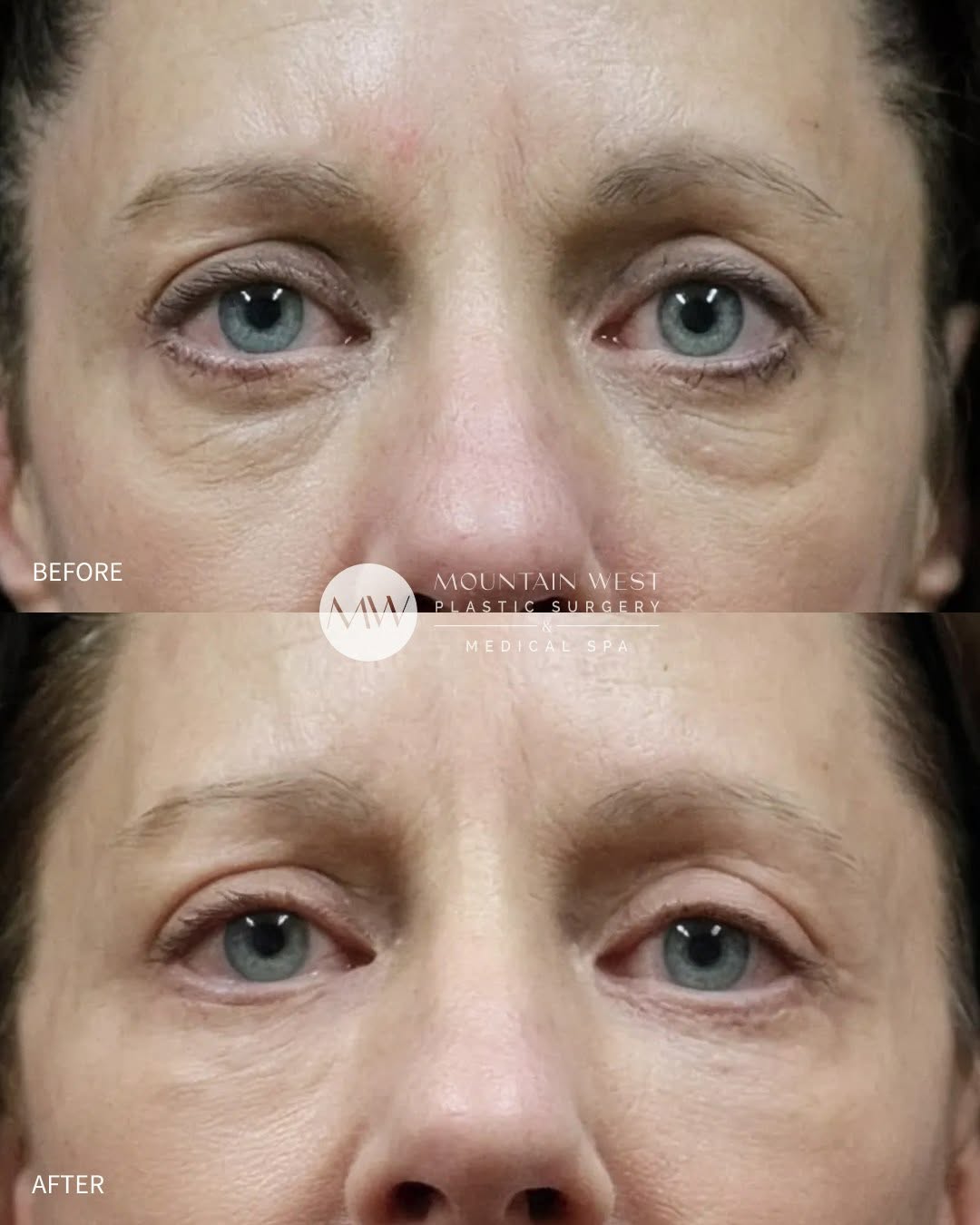 Instagram post by Dr. Michelle Spring: At 58, this patient's biggest concern was her eyes. Heavy lower lid bags that made her look tired even when she was well rested and refreshe…