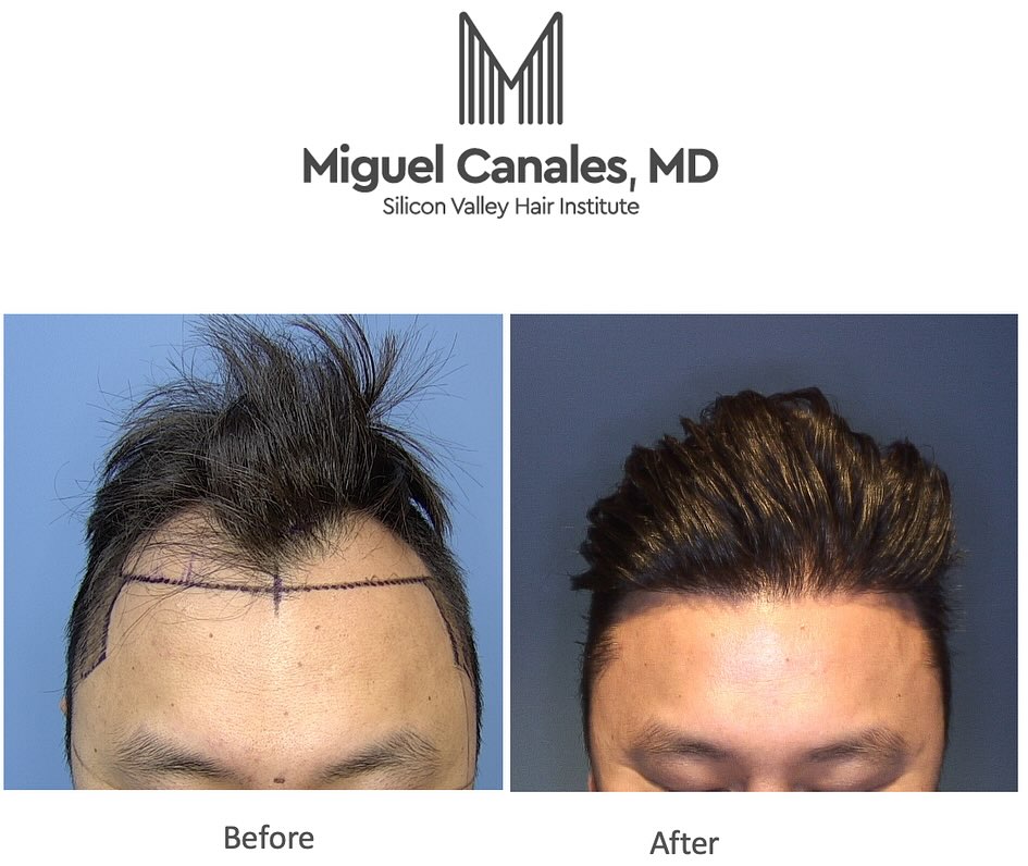 Instagram post by Dr. Miguel Canales: Natural, dense results are possible with a single session with the expertise of Dr Miguel Canales at the Silicon Valley Hair Institute . Exp…
