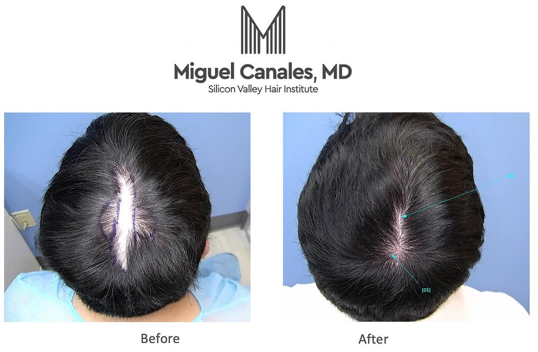 Instagram post by Dr. Miguel Canales: Hair transplants can be used to restore hair growth on scar tissue, effectively camouflaging or even eliminating the appearance of scars on …