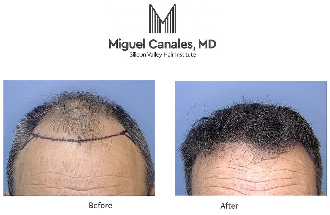 Instagram post by Dr. Miguel Canales: What can a new natural hairline do for you ? Regain confidence ? Look 10 years younger ? Explore your natural hair transplant options with D…