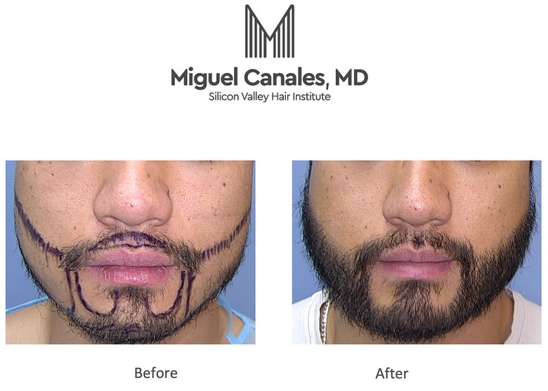 Instagram post by Dr. Miguel Canales: Natural beard transplants can give you the beard you’ve always wanted. Results are permanent and it’s your own natural hair . For more infor…