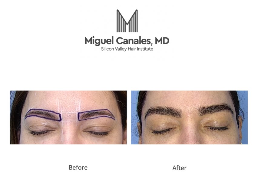 Instagram post by Dr. Miguel Canales: The eyebrow is the quiet architecture of the face-it frames the eyes, shapes expression, and gives beauty its character. Eyebrow transplanta…