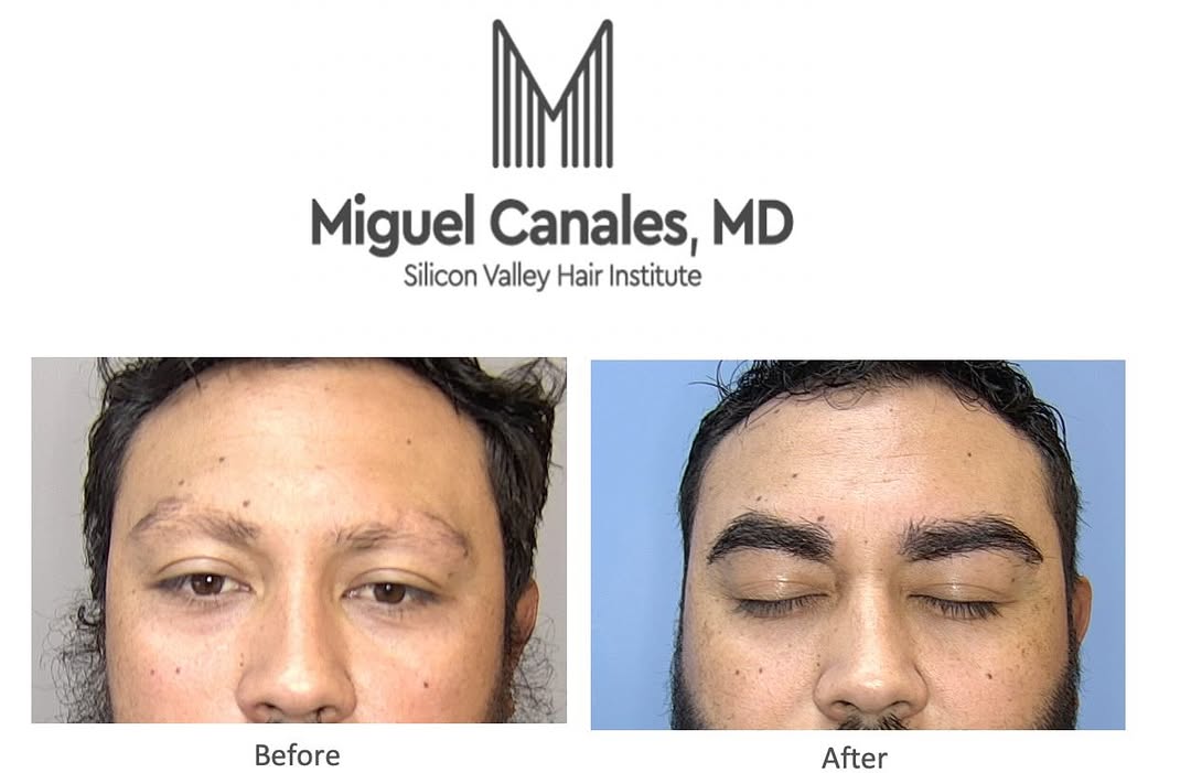 Instagram post by Dr. Miguel Canales: Eyebrow transplants reframe the face and give facial expressions their character. Explore your options for natural eyebrow transplantations …