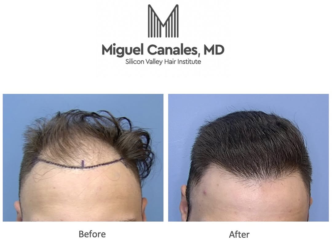 Instagram post by Dr. Miguel Canales: Your natural hair , natural results. Feel confident again . Explore your hair transplant options by scheduling a complimentary consultation …