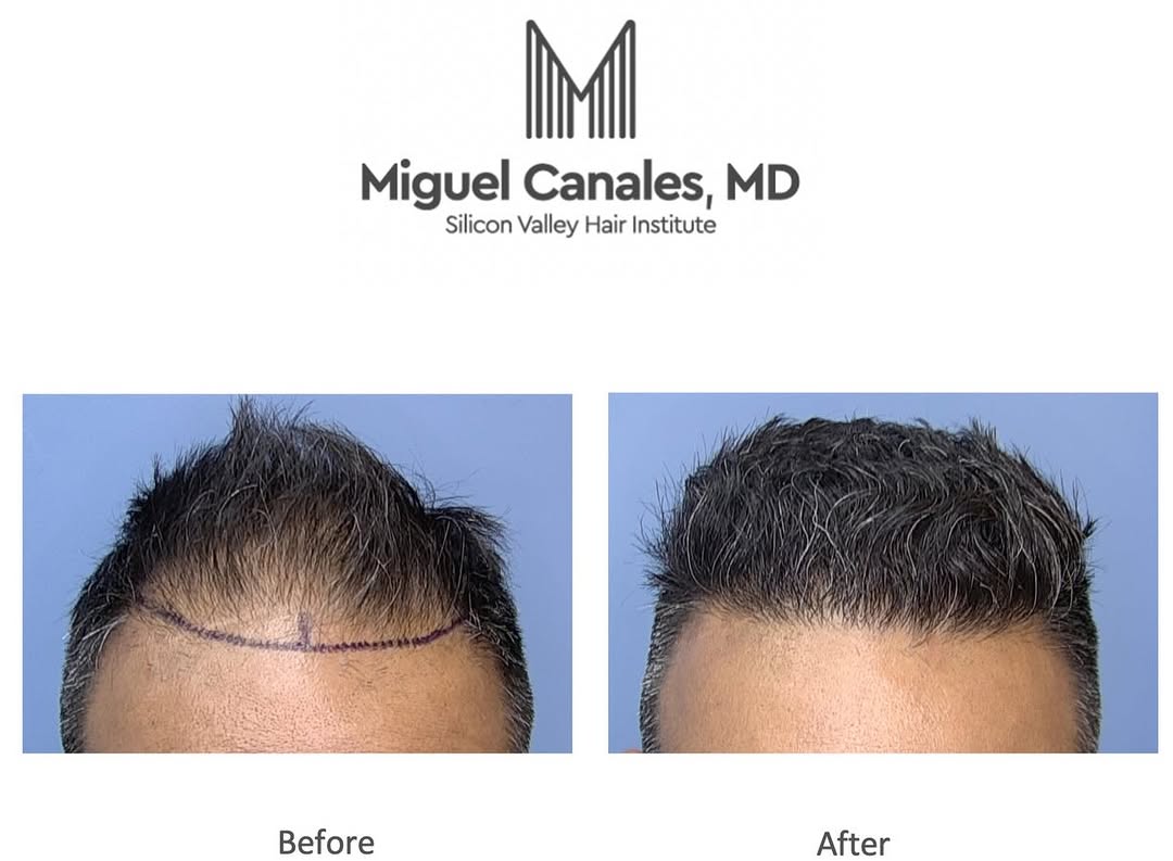 Instagram post by Dr. Miguel Canales: 6 months after hair transplantation this patient expressed happiness for his natural looking hairline and the fullness of the results. He ca…