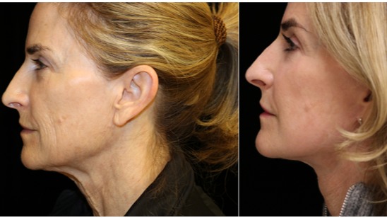 Instagram post by Dr. Miguel Delgado: Our Deep Plane Face Lift procedure provides a comprehensive approach to rejuvenating your appearance, yielding natural-looking long lasting …
