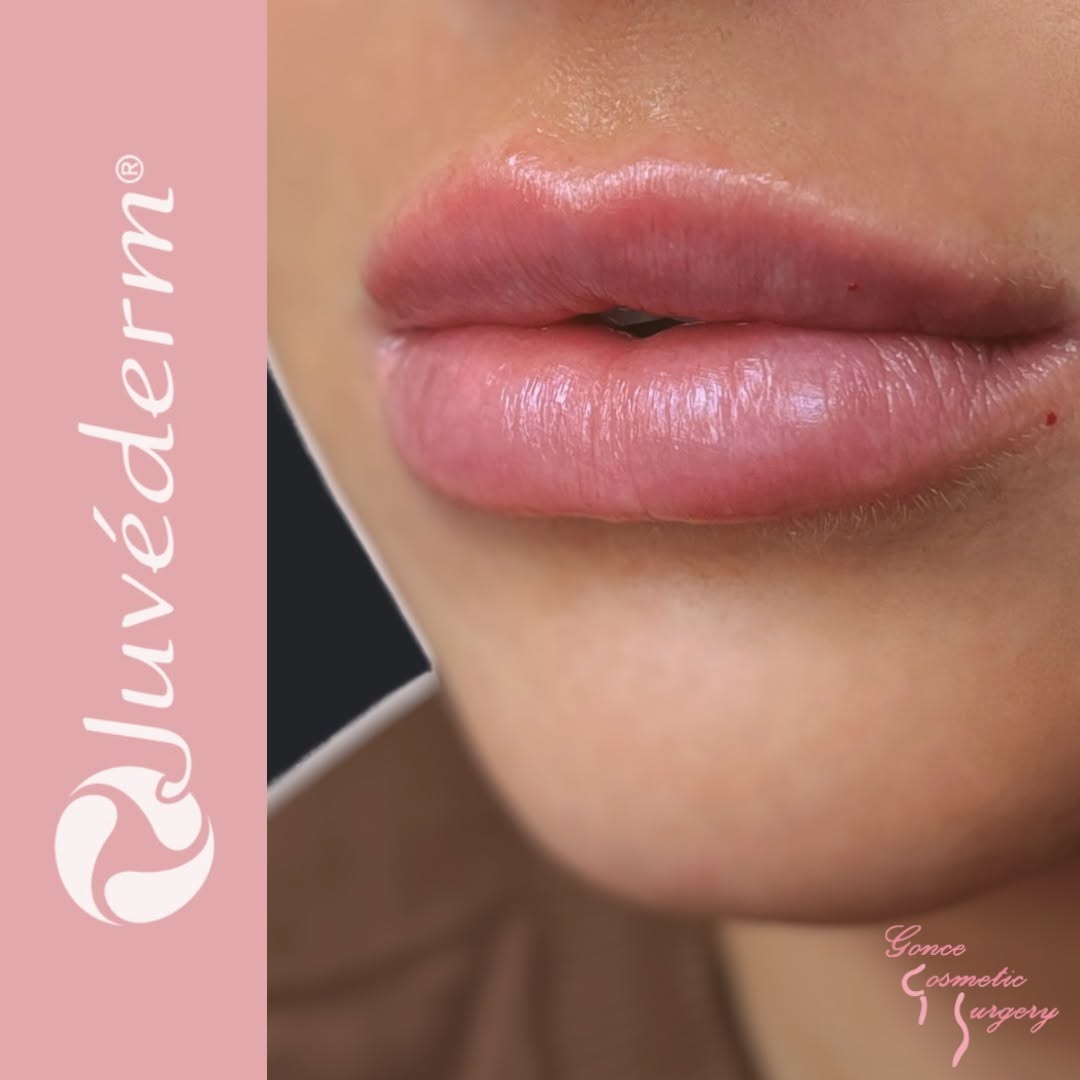 Instagram post by Dr. Mike E. Gonce: Juvederm Ultra Plus results from last week! Results may vary.