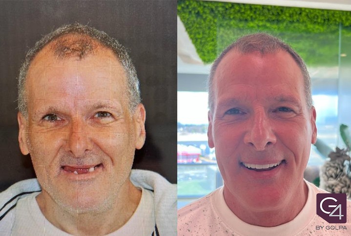 Instagram post by Dr. Mike Golpa, DDS: G4 By Golpa - Fall Savings💰