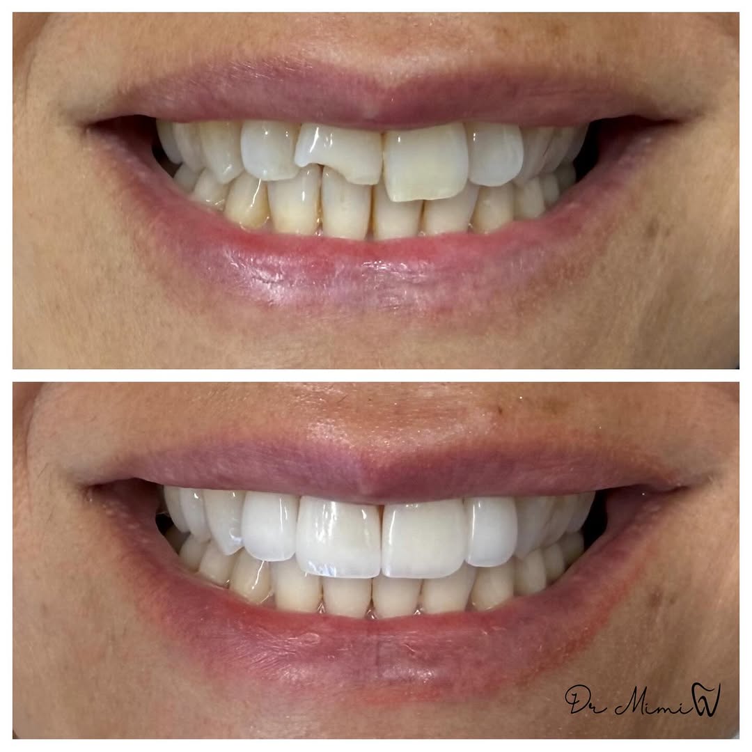 Instagram post by Dr. Mimi Theerathada, D: Imagine flying to Spain for a vacation, tripping and breaking a front tooth on the first day that you land 😳 That’s what happened to our pa…