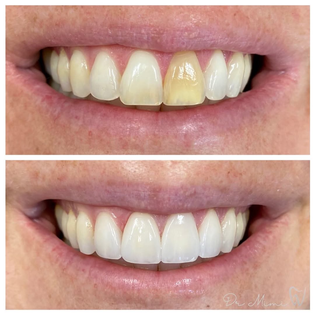 Instagram post by Dr. Mimi Theerathada, D: Great cosmetic dentistry should be seamless and invisible - balance and beauty created by blending in the porcelain with surrounding natural…
