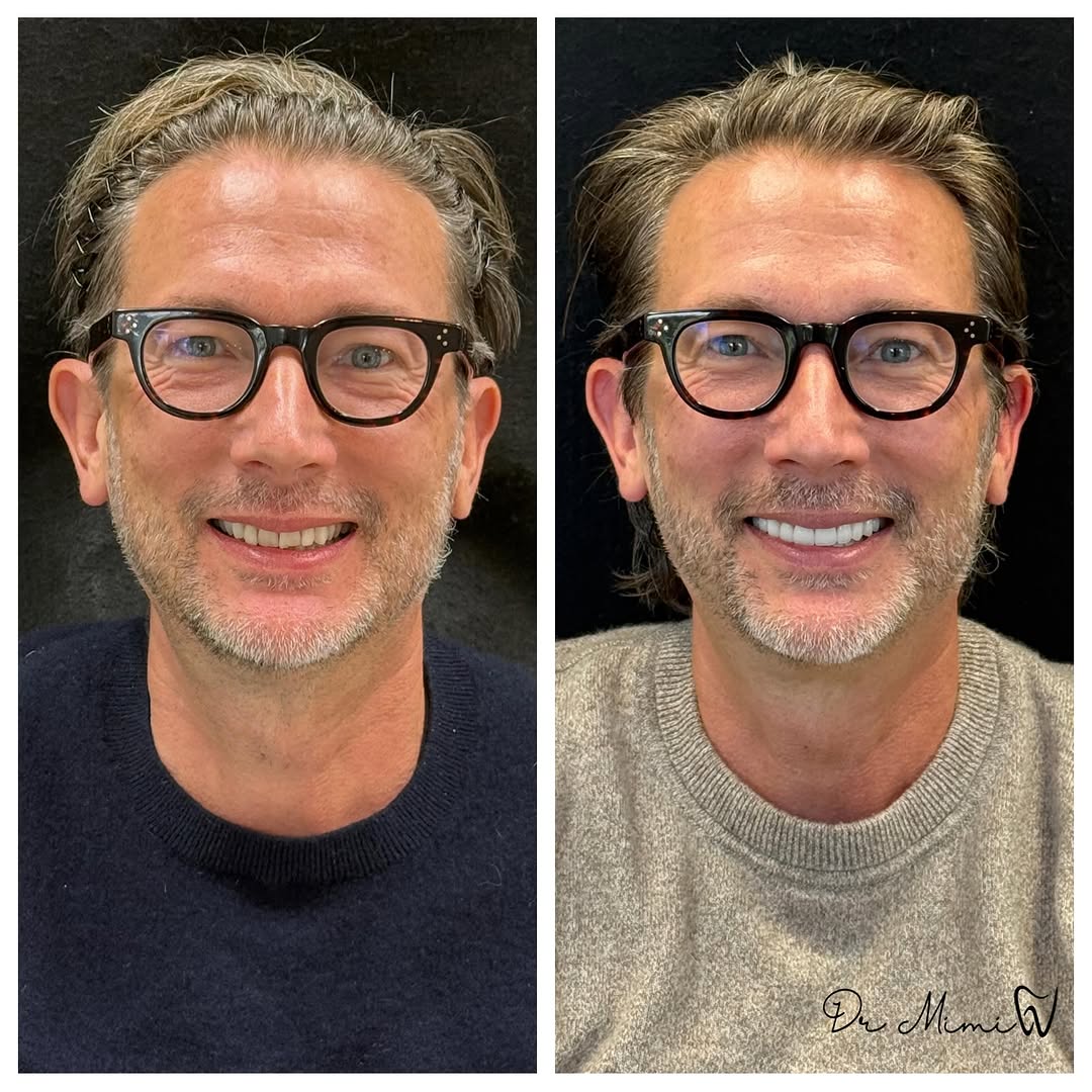 Instagram post by Dr. Mimi Theerathada, D: Transformational dentistry for an already handsome man who just needed to bring back some youth to his face. Years of clenching and grinding…