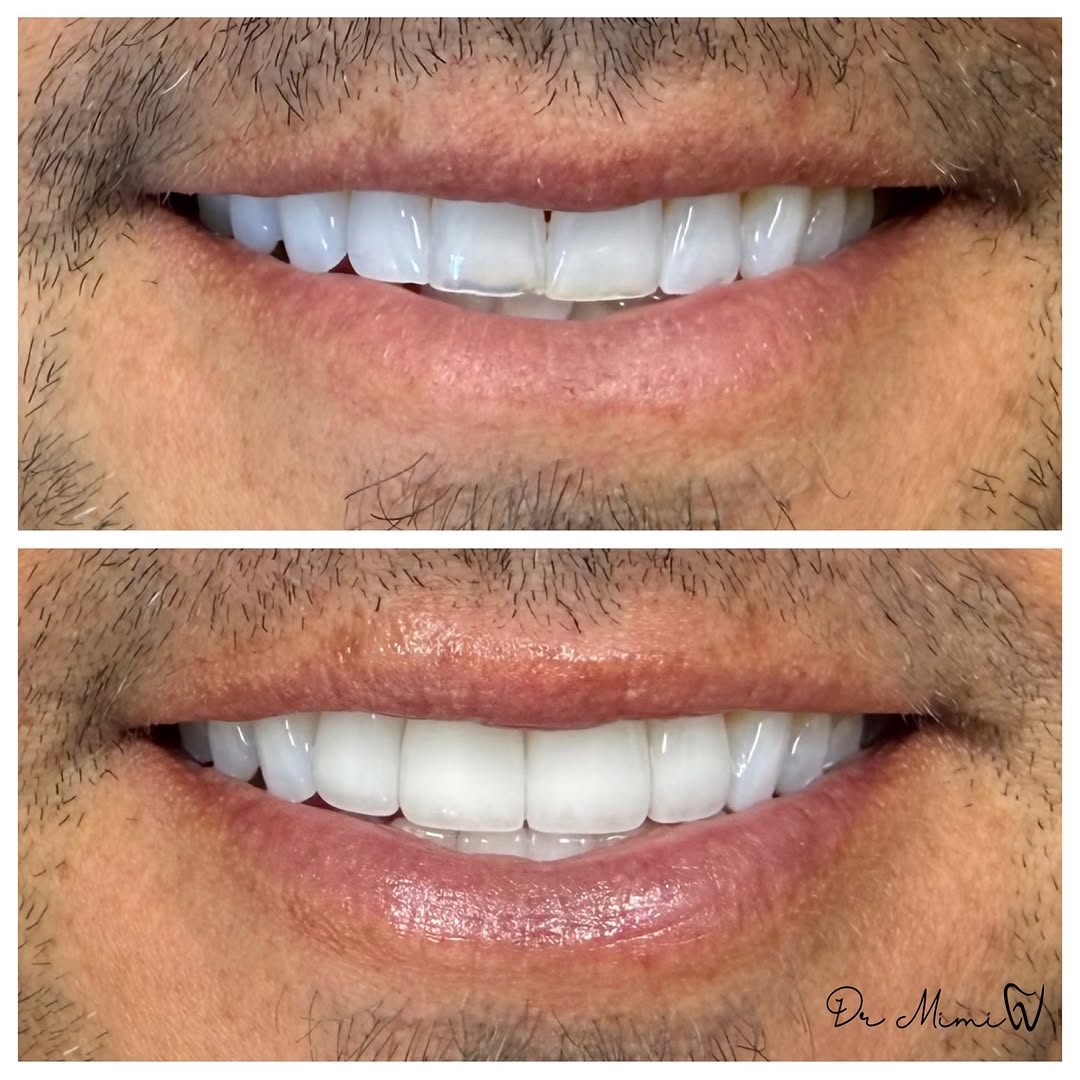 Instagram post by Dr. Mimi Theerathada, D: The goal of cosmetic dentistry is to elevate what nature gave you that may have been lost over the years. It’s not to make you look like a c…