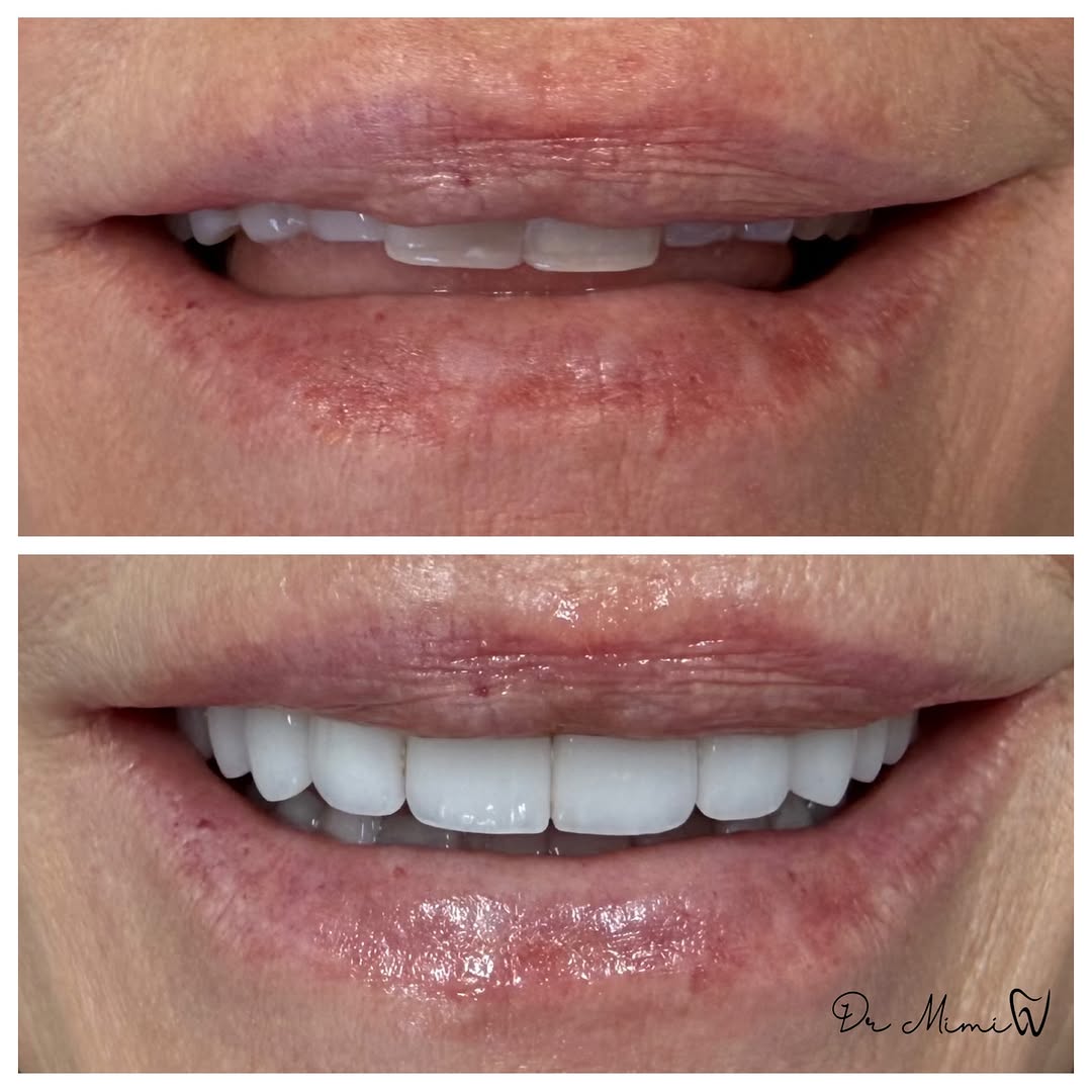 Instagram post by Dr. Mimi Theerathada, D: As we age, we lose length to our teeth from clenching, grinding and simply wear and tear. Additionally, we lose volume in the bottom third o…