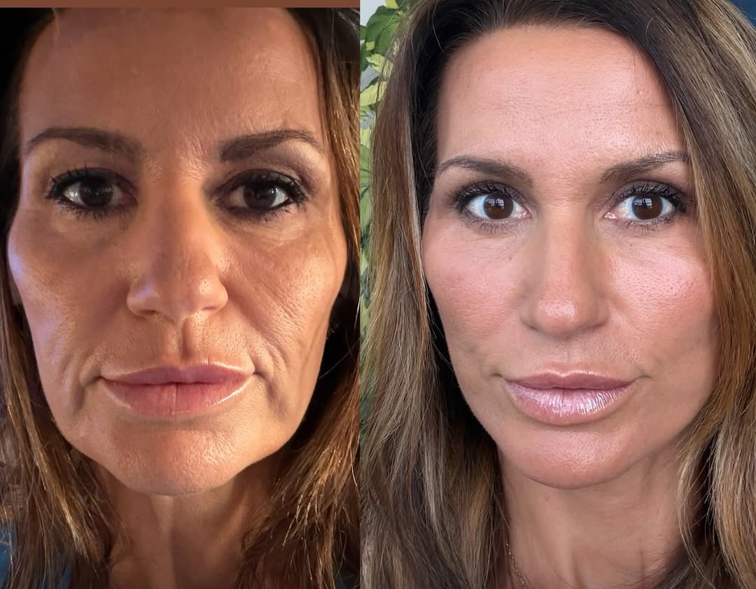 Instagram post by Dr. Min S. Ahn: Four and a half weeks have passed and time has been turned back by years (decades?) Massive weight loss, sun damage, and normal aging were n…