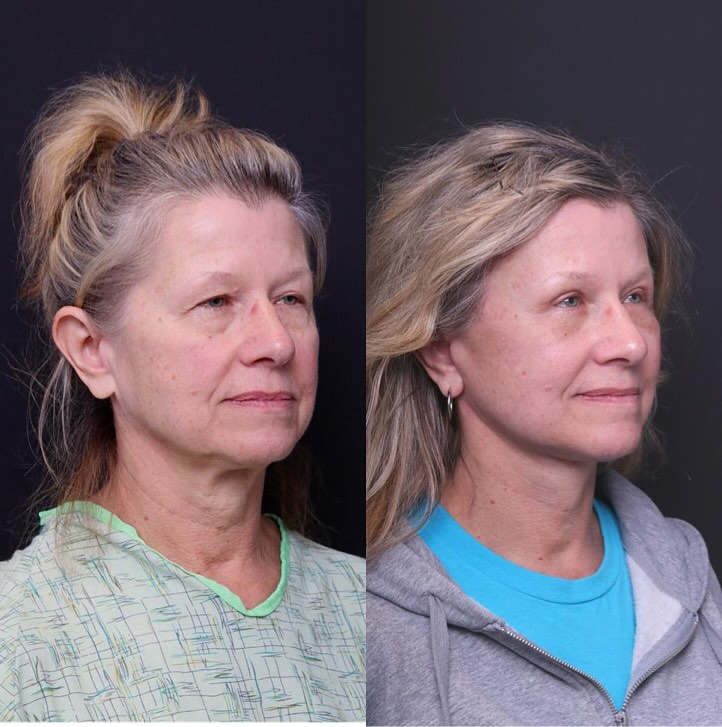 Instagram post by Dr. Mitchell Hagen: Check out my 62 year old lovely patient who came in to address her neck and the heaviness around her eyes. I performed a #deepplanefacelift …