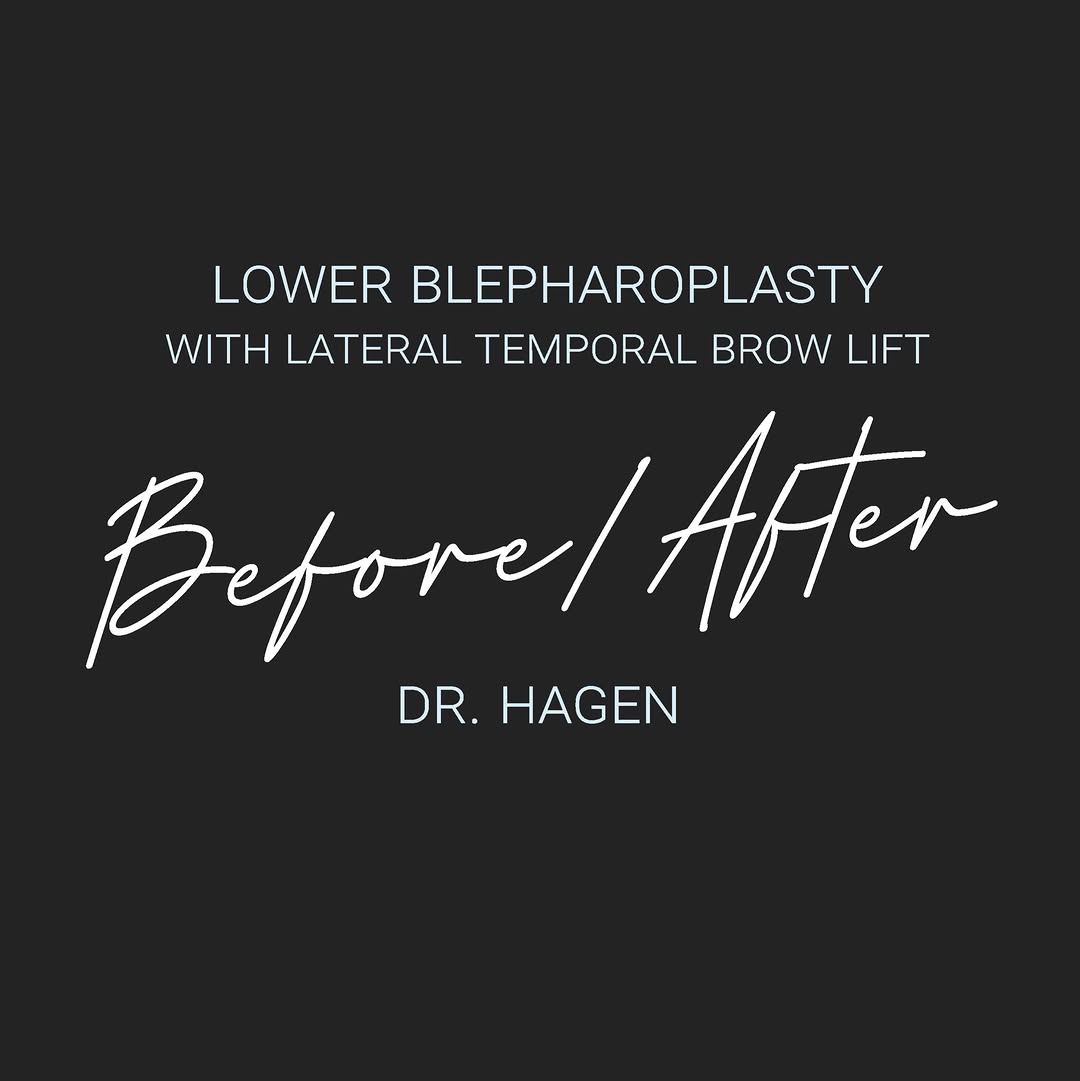Instagram post by Dr. Mitchell Hagen: ✨ Brighter eyes. A naturally refreshed appearance. ✨ The eyes are often one of the first areas to show signs of aging. Under-eye bags, puffi…