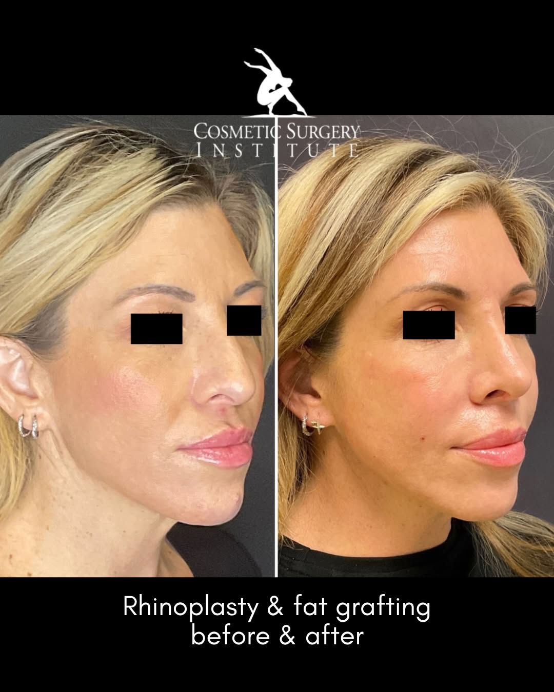 Instagram post by Dr. Mo Zakhireh: Why “one feature” is rarely the full story This beautiful patient came to us convinced her chin was too long — but the truth was more nuance…