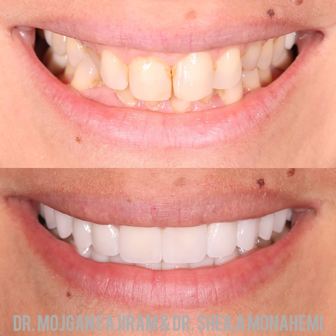 Instagram post by Dr. Mojgan Fajiram, DDS: Hours of meticulous planning where the precision of dentistry meets the creativity of art. Your smile isn't just teeth—it's the chandelier t…